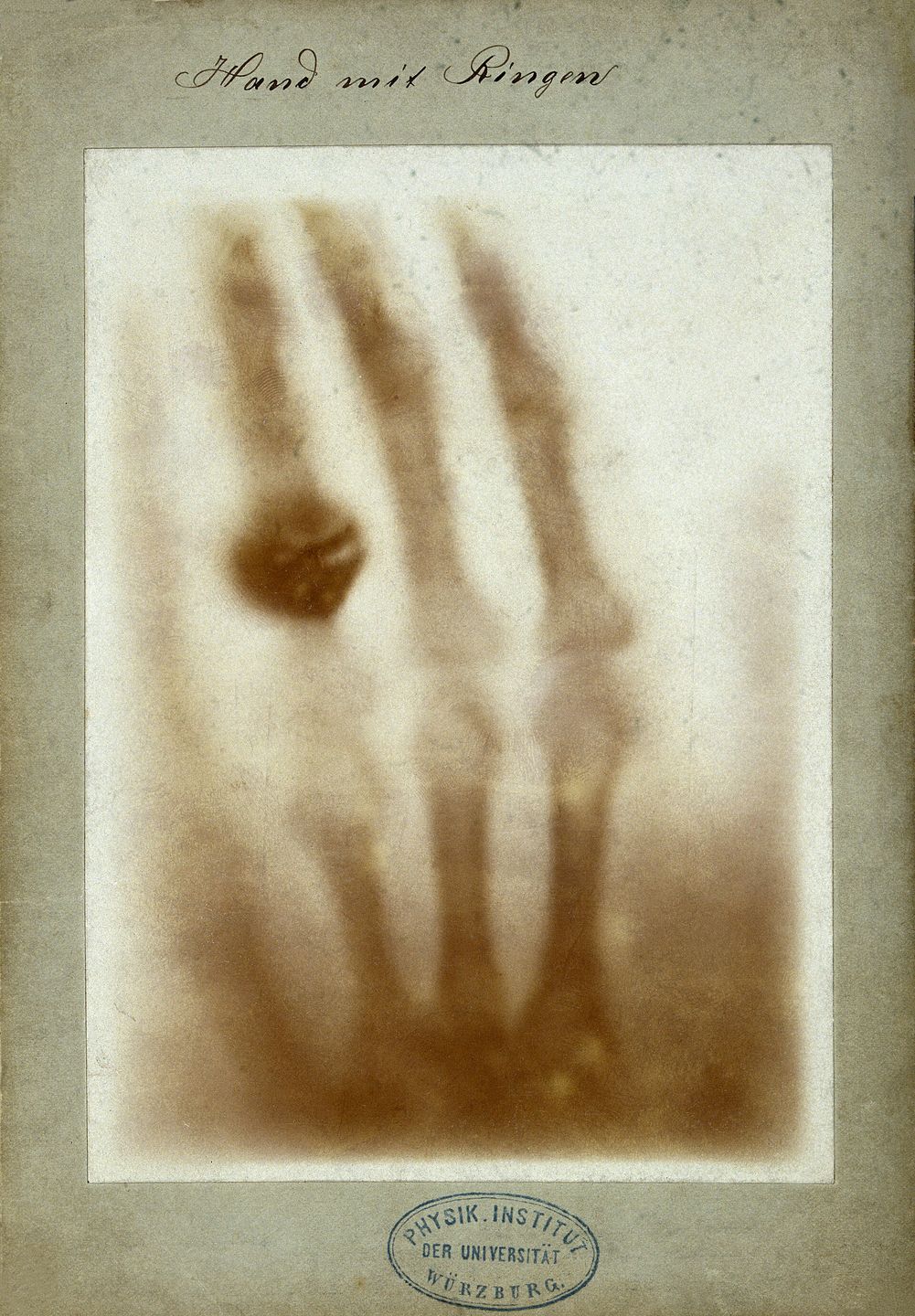 the first medical x-ray, showing the bones and ring of anna bertha röntgen's hand, december 1895
