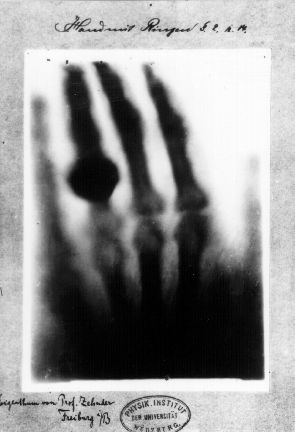 The first medical X-ray, showing the hand of Röntgen's wife