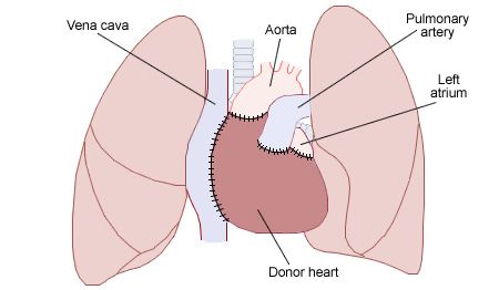 diagram of a heart transplant showing the donor heart connected to the recipient's major vessels