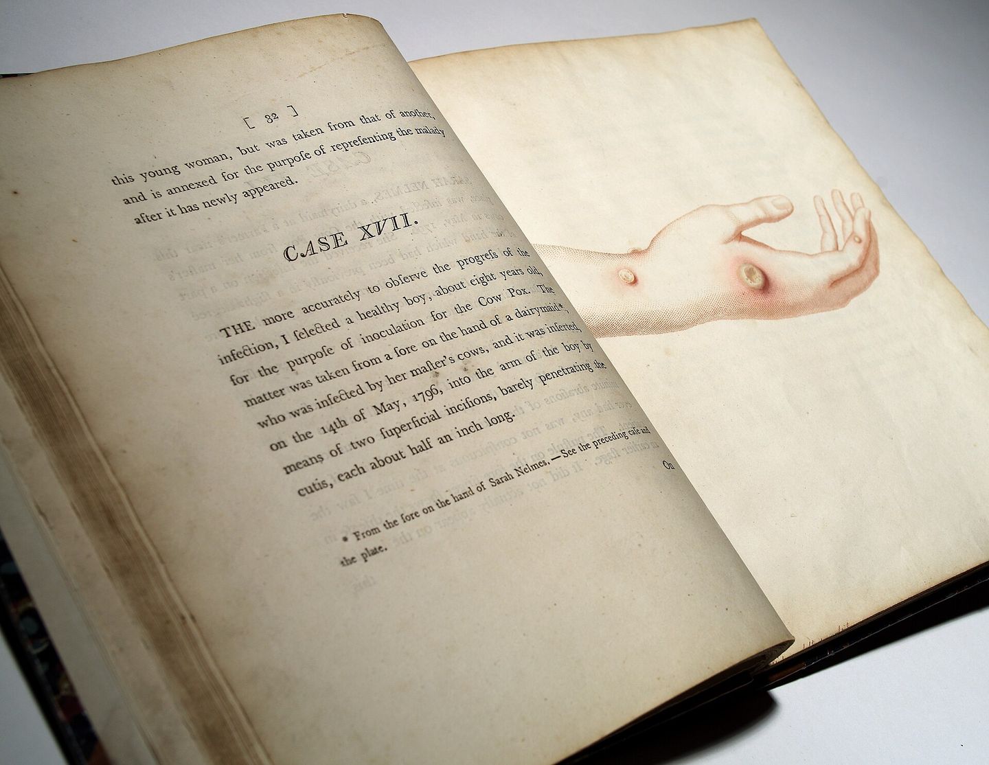 illustration of the hand of milkmaid sarah nelmes showing the cowpox blister jenner used as the source of the first vaccine